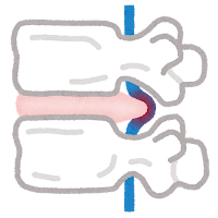 ブログ更新『椎間板ヘルニアは手術した方がいい？』
